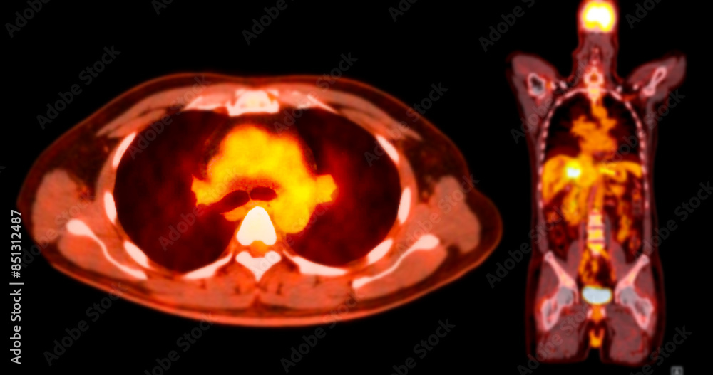 A PET CT scan image shows comprehensive views of organs and tissues ...