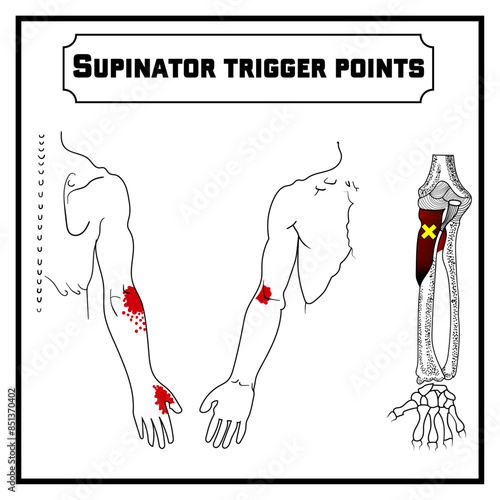 Supinator trigger points vector diagram