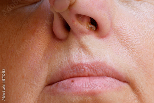 Herpes on the nose - middle-aged caucasian woman with herpes her on nose, Human Virus.