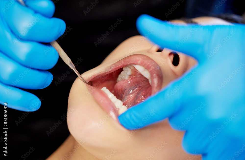 Fototapeta premium Woman, teeth and dentist with mouth tool on patient for dental care, extraction or checkup at clinic. Closeup of female person at dentistry for tooth implant, hygiene or cleaning veneers in surgery