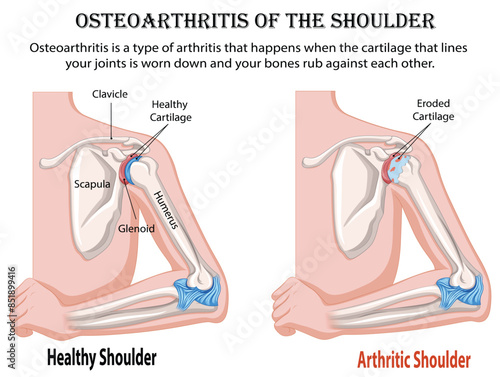 Healthy vs. arthritic shoulder joint diagram on white background