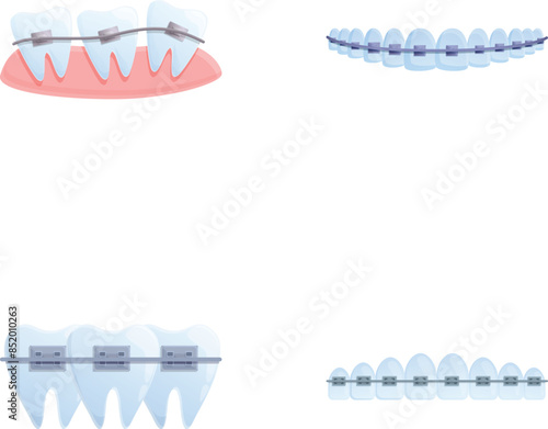 Brace system icons set cartoon vector. Orthodontic brace system on teeth. Orthodontic treatment, bite correction