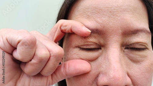 close up the fingers holding the flabbiness adipose and wrinkle around the eyes, ptosis and swelling, dark spots and blemish on the face, health care and beauty concept.
