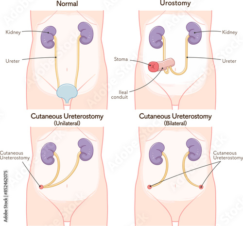 尿路ストーマ、ストーマ、ウロストミー、urostomy、オストメイト、小腸、膀胱、イラスト、illustration