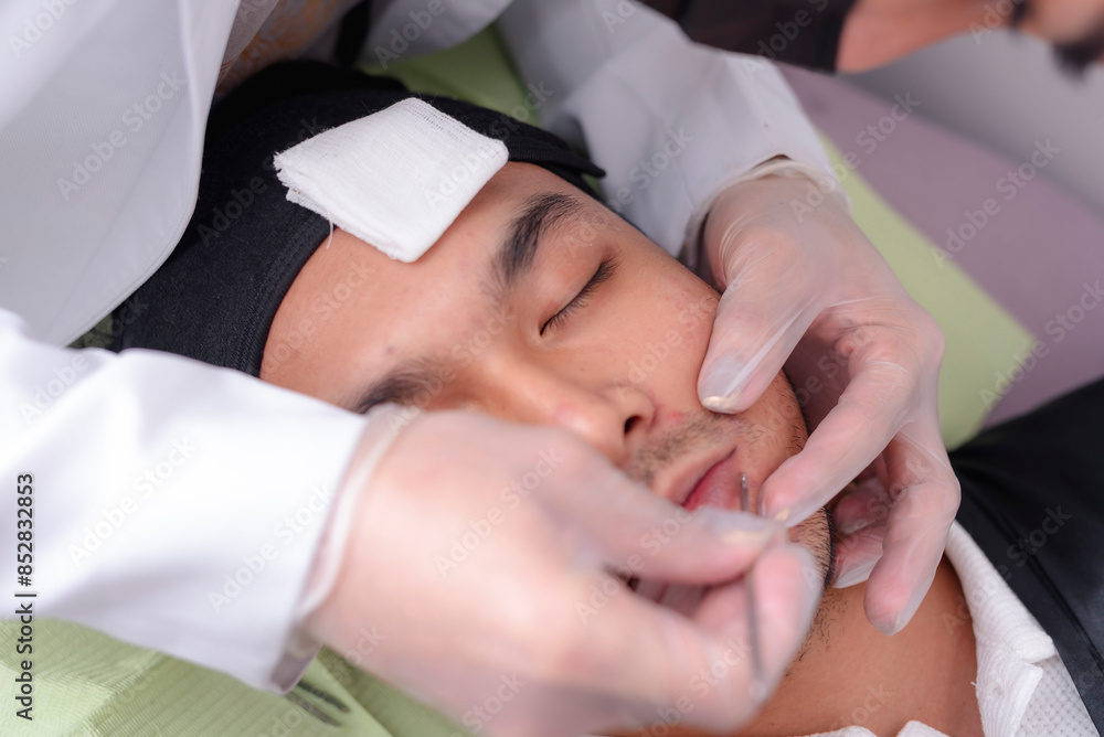An esthetician uses a comedone extractor to precisely remove blackheads on the nose of a male patient. Facial procedure and treatment at a dermatology or aesthetic clinic. An esthetician uses a comedone extractor to precisely remove blackheads on the nose of a male patient. Facial procedure and treatment at a dermatology or aesthetic clinic.