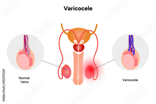 Varicocele, male problem and disease