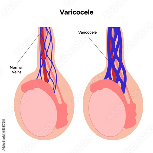 Varicocele disease 