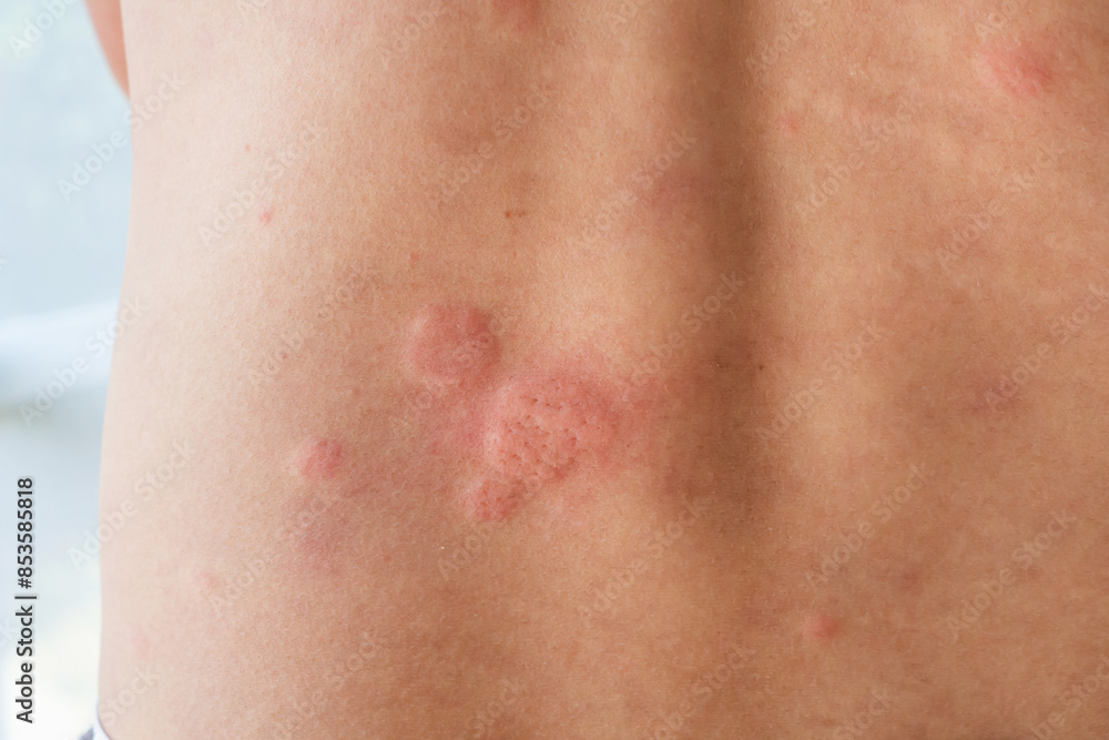 Young asian man itching and scratching on his back from allergic itchy dry skin eczema dermatitis insect bites Young asian man itching and scratching on his back from allergic itchy dry skin eczema dermatitis insect bites