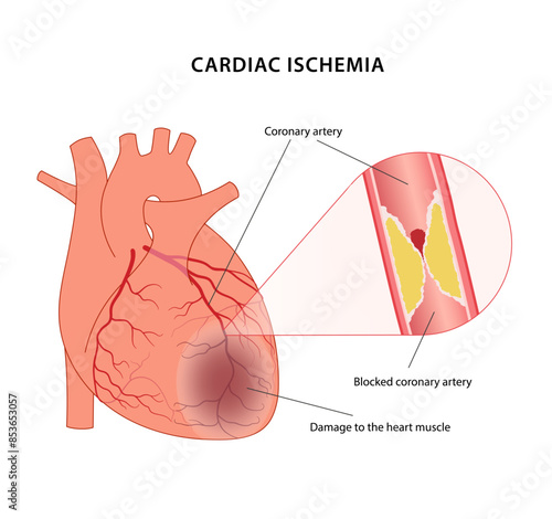 Cardiac ischemia. Medical illustration of a diseased heart with damage to the heart muscle and blocked coronary artery. Vector illustration