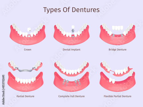 Dentures types. Tooth biting restorations dental care prosthesis teeth implant partial bridge complete full removable denture plastic crown, dentistry swanky illustration