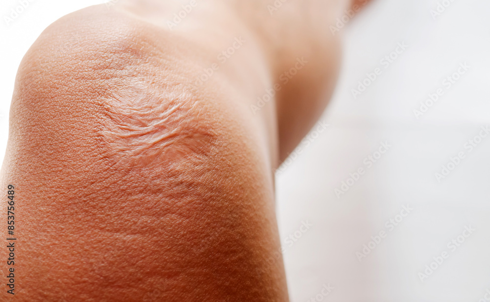 Close-up of scars on knee skin imperfections or defects caused by an accident scar healthcare concept Close-up of scars on knee skin imperfections or defects caused by an accident scar healthcare concept