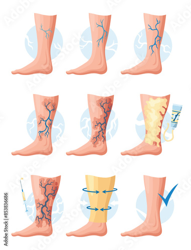Stages or types of varicose veins development. Medical poster or disease infographic. Image of healthy and diseased legs. Vector illustration in flat style