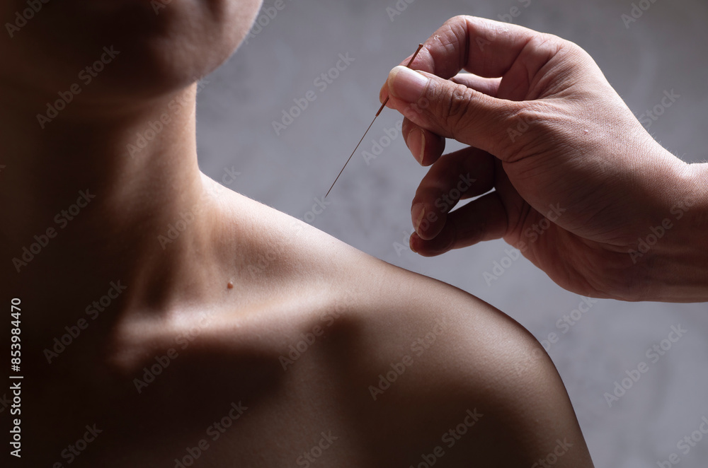 Doctors perform acupuncture and moxibustion treatment for women's shoulders
