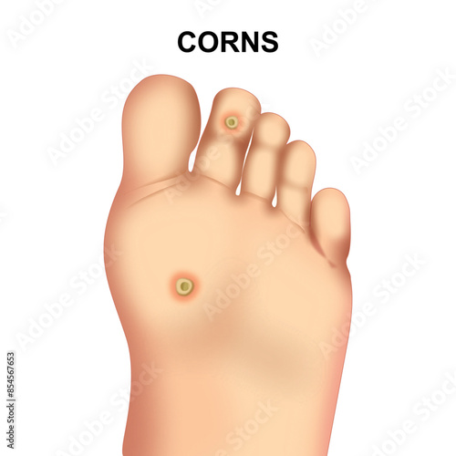 Foot Corns Medical Illustration 