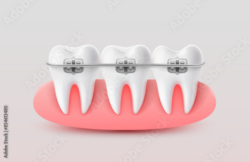Installing braces on teeth, straightening crooked bites. Vector illustration
