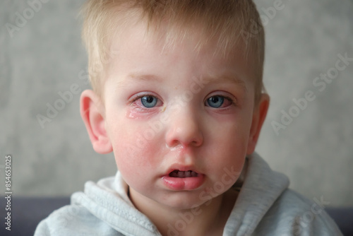 Red swollen eyes from conjunctivitis child, ill allergic eyes in babies. Close-up of a baby with conjunctivitis