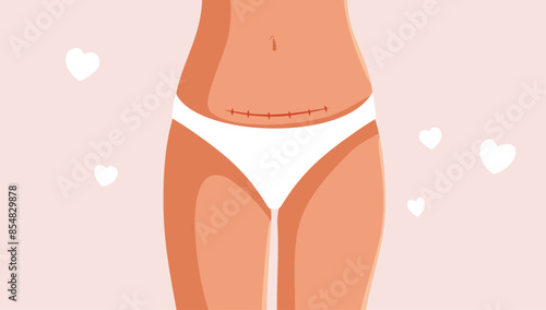 Woman Proudly Showing Her C Section Vector Cartoon Illustration. Postpartum body of a new mom with love scar 
