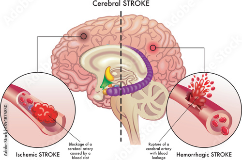 Medical illustration compares the causes of two types of cerebral stroke, an ischemic stroke, and a hemorrhagic stroke, which affect the cerebral arteries, with annotations