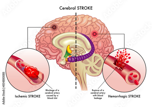 Medical illustration compares the causes of two types of cerebral stroke, an ischemic stroke, and a hemorrhagic stroke, which affect the cerebral arteries, with annotations