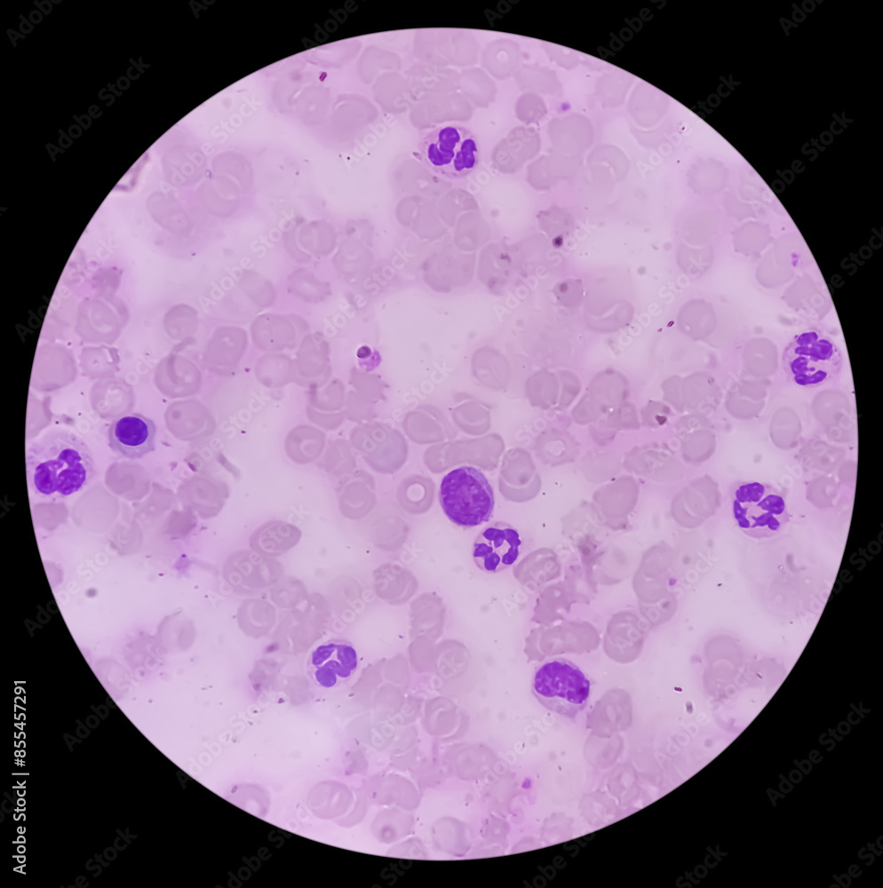 Bone marrow study (BMS).Panmyelosis. Myeloproliferative disorder. Acute ...