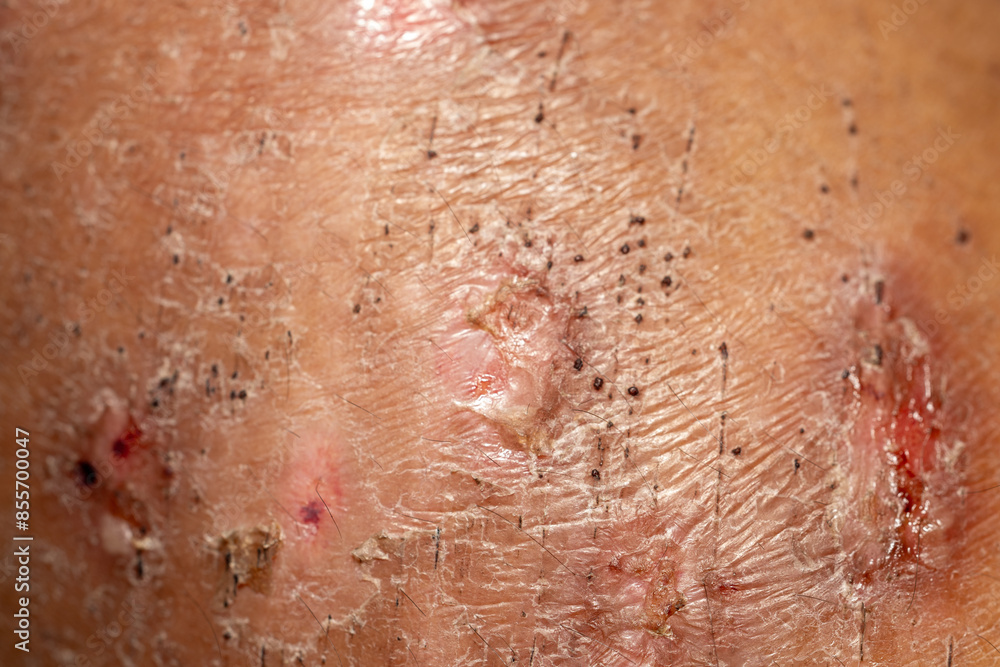 Fototapeta premium Background image of wounds caused by Systemic Lupus erythematosus (SLE) or Lupus.