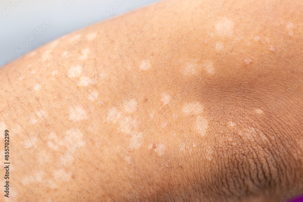 Fototapeta premium Background image of wounds caused by Systemic Lupus erythematosus (SLE) or Lupus.