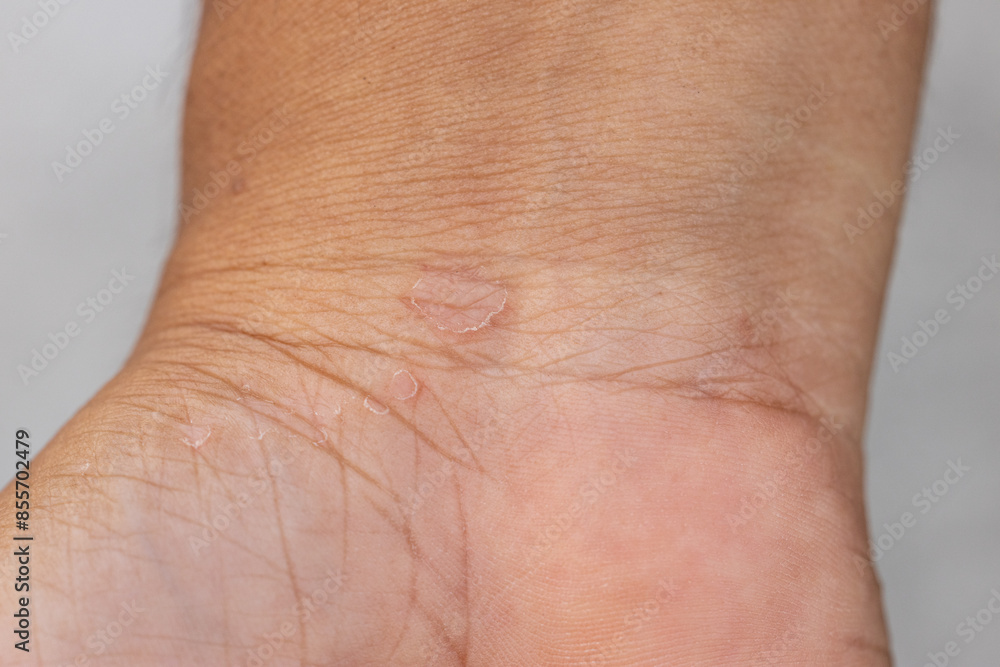 Background image of wounds caused by Systemic Lupus erythematosus (SLE) or Lupus. Background image of wounds caused by Systemic Lupus erythematosus (SLE) or Lupus.