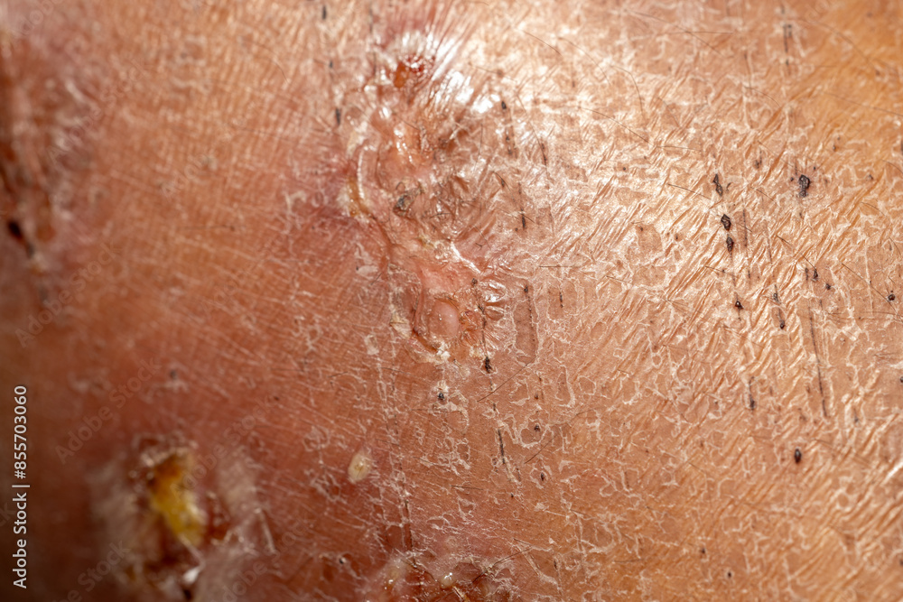 Fototapeta premium Background image of wounds caused by Systemic Lupus erythematosus (SLE) or Lupus.