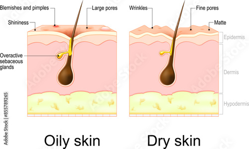 Oily and Dry skin. Skin types. Cross section of a human skin