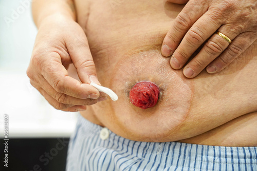 Man cleaning the stoma in the bathroom. Health care after colon cancer