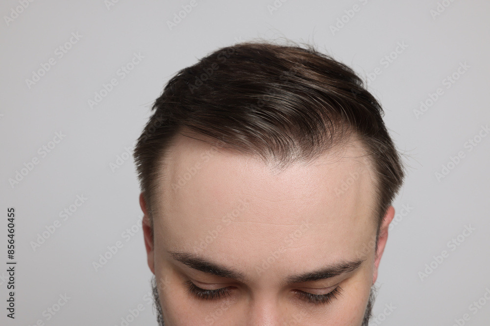 Baldness concept. Man with receding hairline on light grey background, closeup Baldness concept. Man with receding hairline on light grey background, closeup