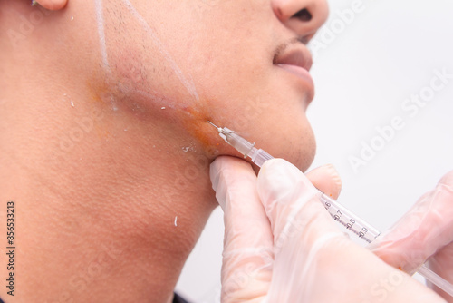 Foto Jawline filler procedure for male patient