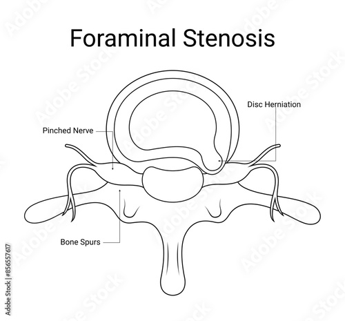 Diagram of foraminal stenosis medical design in line style