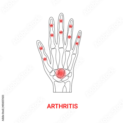 Arthritis medical design in line style illustration