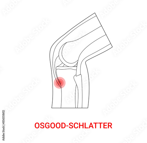 Osgood schlatter medical design with line style