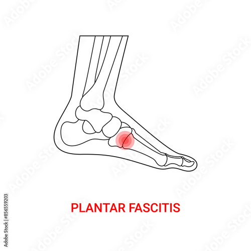 Plantar fascitis medical design with line style