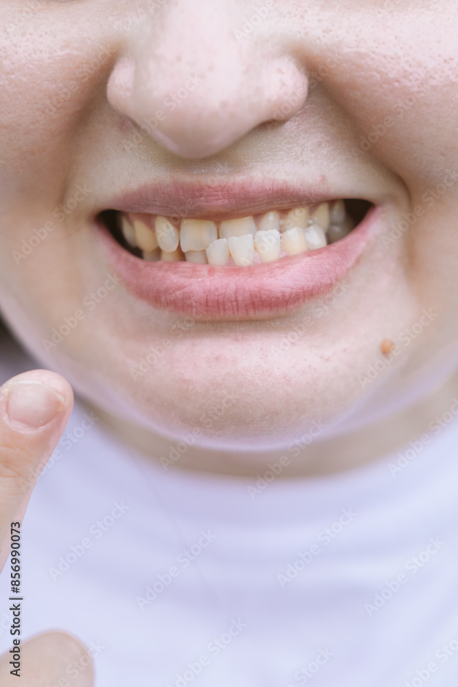 Patient with dislocated jaw and malocclusion, temporomandibular joint
