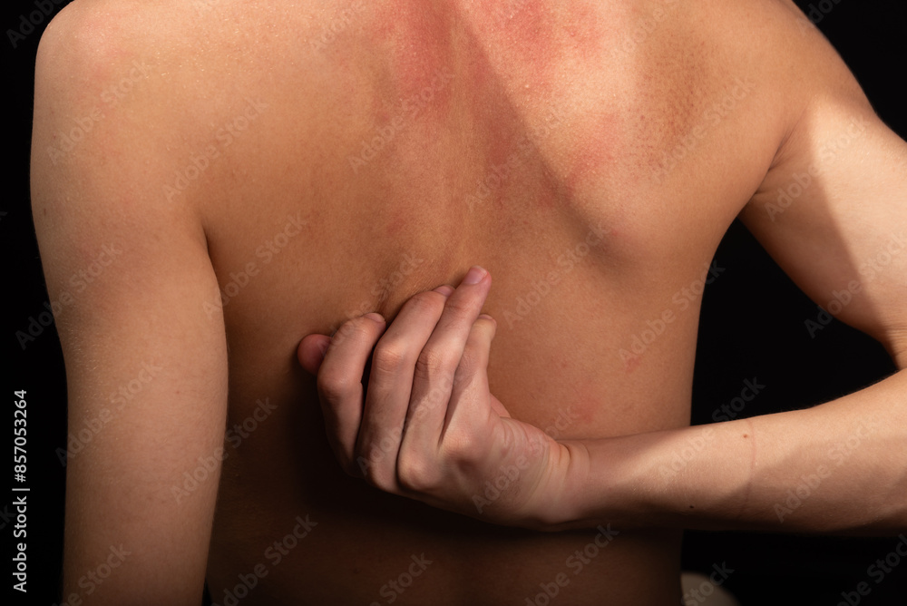 Young man, shirtless, scratching his back with his hands. Skin disease. Irritation, allergy. Young man, shirtless, scratching his back with his hands. Skin disease. Irritation, allergy.