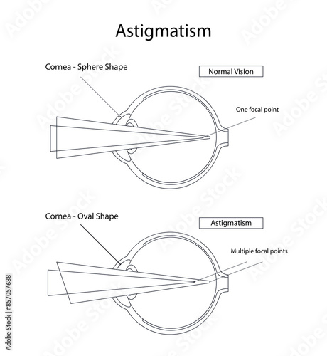 Medical design astigmatism disease with line illustration