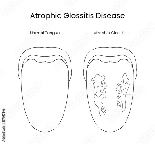 Atrophic glosstic disease in line illustration photo