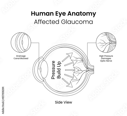 Human eye anatomy affected glaucoma in line style