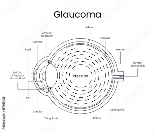 Diagram of glaucoma disease in line style