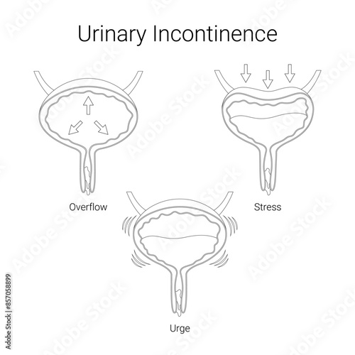 Types of urinary incontinence in line illustration