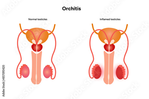 Male Orchitis Testis Inflamed and normal testicles 