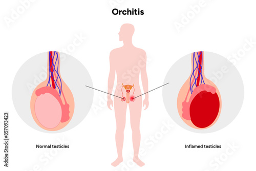 Male Orchitis Testis Inflamed and normal testicles with man mannequin