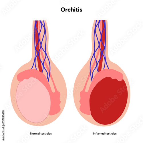 Male Orchitis Testis Inflamed and normal testicles