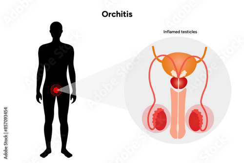 Male Orchitis Testis Inflamed and normal testicles with man mannequin