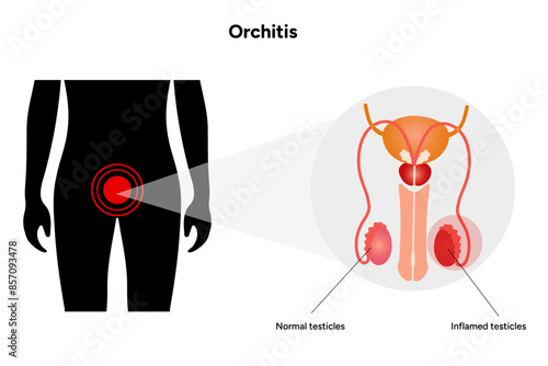 Male Orchitis Testis Inflamed and normal testicles with man mannequin