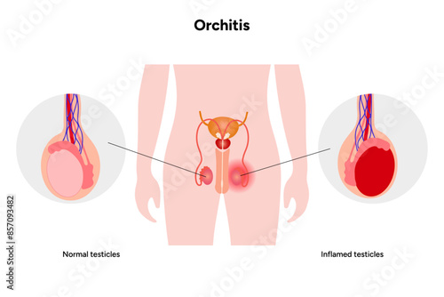 Male Orchitis Testis Inflamed and normal testicles with man mannequin
