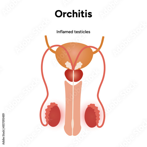 Male Orchitis Testis Inflamed testicles